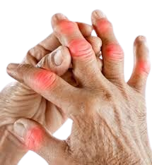 Hand with highlighted joint pain areas — rheumatoid arthritis symptoms